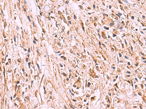 GPC2 / Glypican 2 Antibody - Immunohistochemistry of paraffin-embedded Human prost ate cancer tissue  using GPC2 Polyclonal Antibody at dilution of 1:35(×200)