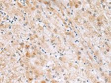 GPC2 / Glypican 2 Antibody - Immunohistochemistry of paraffin-embedded Human liver cancer tissue  using GPC2 Polyclonal Antibody at dilution of 1:40(×200)