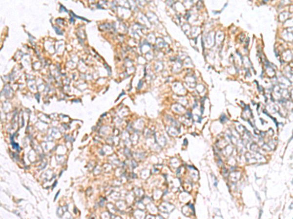 GPC2 / Glypican 2 Antibody - Immunohistochemistry of paraffin-embedded Human colorectal cancer tissue  using GPC2 Polyclonal Antibody at dilution of 1:40(×200)