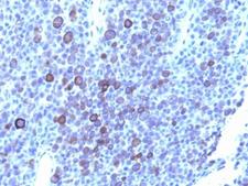 GPC3 / Glypican 3 Antibody - Formalin-fixed, paraffin-embedded human melanoma stained with Glypican-3 antibody (1G12 + GPC3/863).  This image was taken for the unmodified form of this product. Other forms have not been tested.