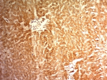 GPC3 / Glypican 3 Antibody - Formalin-fixed, paraffin-embedded human hepatocellular carcinoma stained with Glypican-3 antibody (1G12).  This image was taken for the unmodified form of this product. Other forms have not been tested.