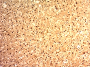 GPC3 / Glypican 3 Antibody - Formalin-fixed, paraffin-embedded human hepatocellular carcinoma stained with Glypican-3 antibody (SPM595).  This image was taken for the unmodified form of this product. Other forms have not been tested.
