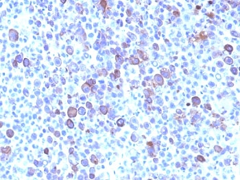 GPC3 / Glypican 3 Antibody - Formalin-fixed, paraffin-embedded human melanoma stained with Glypican-3 antibody (SPM595).  This image was taken for the unmodified form of this product. Other forms have not been tested.