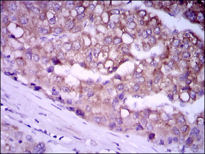 GPC3 / Glypican 3 Antibody - IHC of paraffin-embedded liver cancer tissues using GPC3 mouse monoclonal antibody with DAB staining.