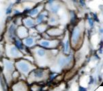 GPC3 / Glypican 3 Antibody - IHC of Glypican-3 on FFPE Ovarian Carcinoma tissue. This image was taken for the unmodified form of this product. Other forms have not been tested.