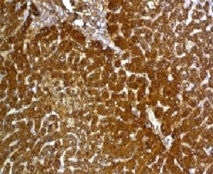 GPC3 / Glypican 3 Antibody - Formalin-fixed, paraffin-embedded human hepatocellular carcinoma stained with Glypican-3 antibody (GPC3/863).  This image was taken for the unmodified form of this product. Other forms have not been tested.