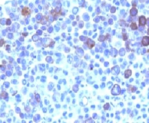 GPC3 / Glypican 3 Antibody - Formalin-fixed, paraffin-embedded human melanoma stained with Glypican-3 antibody (GPC3/863).  This image was taken for the unmodified form of this product. Other forms have not been tested.