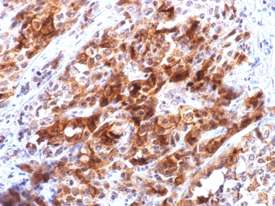 GPC3 / Glypican 3 Antibody - Formalin-fixed, paraffin-embedded human Hepatocellular Carcinoma stained with Glypican-3 Mouse Recombinant Monoclonal Ab (rGPC3/863).