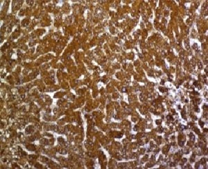 GPC3 / Glypican 3 Antibody - IHC testing of FFPE human hepatocellular carcinoma with Glypican-3 antibody (SGPN3-1).  This image was taken for the unmodified form of this product. Other forms have not been tested.