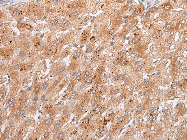 GPC4 / Glypican 4 Antibody - Immunohistochemistry of paraffin-embedded Human liver cancer tissue  using GPC4 Polyclonal Antibody at dilution of 1:30(×200)
