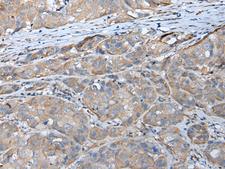 GPC5 / Glypican 5 Antibody - Immunohistochemistry of paraffin-embedded Human breast cancer tissue  using GPC5 Polyclonal Antibody at dilution of 1:40(×200)