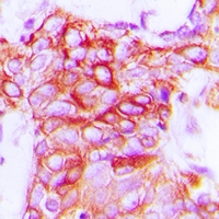 GPCR6 / GPR101 Antibody - Immunohistochemical analysis of GPR101 staining in human breast cancer formalin fixed paraffin embedded tissue section. The section was pre-treated using heat mediated antigen retrieval with sodium citrate buffer (pH 6.0). The section was then incubated with the antibody at room temperature and detected using an HRP polymer system. DAB was used as the chromogen. The section was then counterstained with hematoxylin and mounted with DPX.