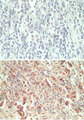 GPCRW / GPR18 Antibody - IHC ofGPR18 in paraffin-embedded formalin-fixed human breast tumor tissue using an isotype control (top) and Peptide-affinity Purified Polyclonal Antibody to GPR18 (bottom) at 5 ug/ml.