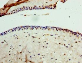 GPD1 Antibody - Immunohistochemistry of paraffin-embedded human breast cancer tissue using antibody at 1:100 dilution.  This image was taken for the unconjugated form of this product. Other forms have not been tested.
