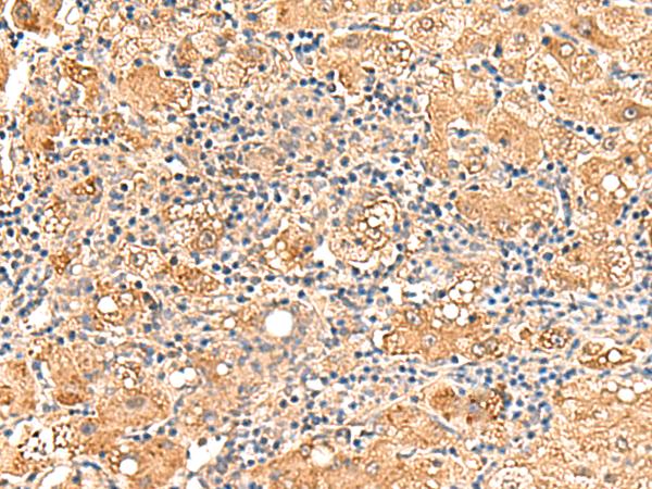 GPD1L Antibody - Immunohistochemistry of paraffin-embedded Human liver cancer tissue  using GPD1L Polyclonal Antibody at dilution of 1:60(×200)