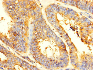 GPD2 Antibody - Immunohistochemistry of paraffin-embedded human endometrial cancer using GPD2 Antibody at dilution of 1:100
