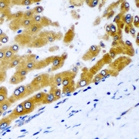 GPD2 Antibody - Immunohistochemical analysis of GPD2 staining in human liver cancer formalin fixed paraffin embedded tissue section. The section was pre-treated using heat mediated antigen retrieval with sodium citrate buffer (pH 6.0). The section was then incubated with the antibody at room temperature and detected using an HRP conjugated compact polymer system. DAB was used as the chromogen. The section was then counterstained with hematoxylin and mounted with DPX.