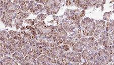 GPD2 Antibody - 1:100 staining human pancreas carcinoma tissue by IHC-P. The sample was formaldehyde fixed and a heat mediated antigen retrieval step in citrate buffer was performed. The sample was then blocked and incubated with the antibody for 1.5 hours at 22°C. An HRP conjugated goat anti-rabbit antibody was used as the secondary.