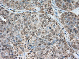 GPI Antibody - Immunohistochemical staining of paraffin-embedded Adenocarcinoma of Human ovary tissue using anti-GPI mouse monoclonal antibody. (Dilution 1:50).