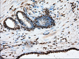 GPI Antibody - Immunohistochemical staining of paraffin-embedded Carcinoma of Human prostate tissue using anti-GPI mouse monoclonal antibody. (Dilution 1:50).
