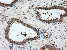 GPI Antibody - Immunohistochemical staining of paraffin-embedded Carcinoma of Human prostate tissue using anti-GPI mouse monoclonal antibody. (Dilution 1:50).