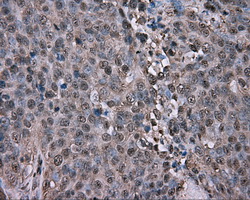 GPI Antibody - IHC of paraffin-embedded Adenocarcinoma of ovary tissue using anti-GPI mouse monoclonal antibody. (Dilution 1:50).