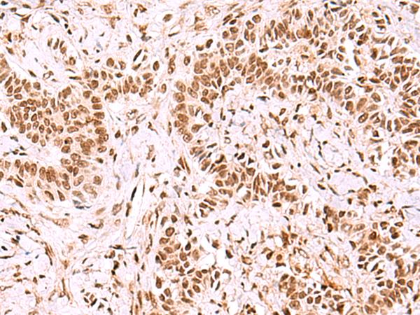 GPKOW Antibody - Immunohistochemistry of paraffin-embedded Human ovarian cancer tissue  using GPKOW Polyclonal Antibody at dilution of 1:100(×200)