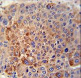 GPLD1 / GPIPLD Antibody - GPLD1 Antibody immunohistochemistry of formalin-fixed and paraffin-embedded human hepatocarcinoma tissue followed by peroxidase-conjugated secondary antibody and DAB staining.