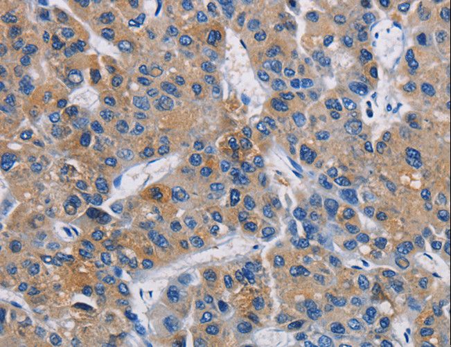 GPM6A / Glycoprotein M6A Antibody - Immunohistochemistry of paraffin-embedded Human liver cancer using GPM6A Polyclonal Antibody at dilution of 1:40.