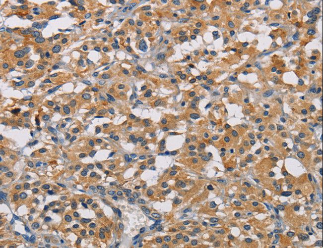 GPM6A / Glycoprotein M6A Antibody - Immunohistochemistry of paraffin-embedded Human thyroid cancer using GPM6A Polyclonal Antibody at dilution of 1:50.