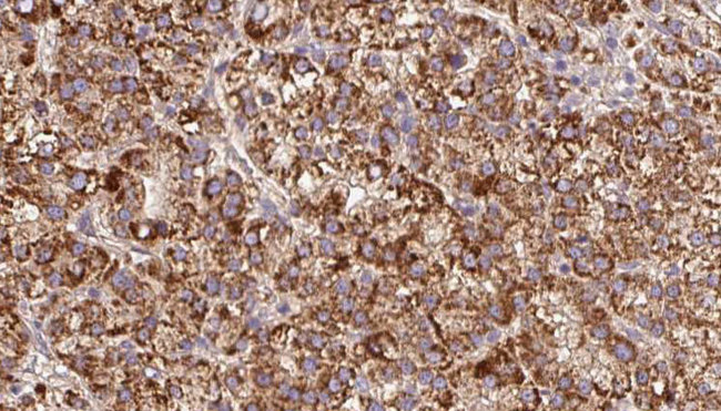 GPM6A / Glycoprotein M6A Antibody - 1:100 staining human liver carcinoma tissues by IHC-P. The sample was formaldehyde fixed and a heat mediated antigen retrieval step in citrate buffer was performed. The sample was then blocked and incubated with the antibody for 1.5 hours at 22°C. An HRP conjugated goat anti-rabbit antibody was used as the secondary.