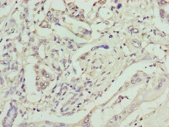 GPM6B Antibody - Immunohistochemistry of paraffin-embedded human pancreatic cancer using GPM6B Antibody at dilution of 1:100