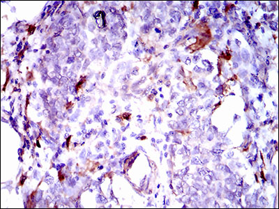 GPNMB / Osteoactivin Antibody - IHC of paraffin-embedded breast cancer tissues using GPNMB mouse monoclonal antibody with DAB staining.