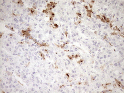 GPNMB / Osteoactivin Antibody - Immunohistochemical staining of paraffin-embedded Human liver tissue within the normal limits using anti-GPNMB mouse monoclonal antibody. (Heat-induced epitope retrieval by 1mM EDTA in 10mM Tris buffer. (pH8.5) at 120°C for 3 min. (1:150)