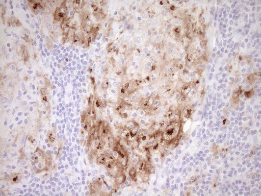 GPNMB / Osteoactivin Antibody - Immunohistochemical staining of paraffin-embedded Human lymph node tissue within the normal limits using anti-GPNMB mouse monoclonal antibody. (Heat-induced epitope retrieval by 1mM EDTA in 10mM Tris buffer. (pH8.5) at 120°C for 3 min. (1:150)