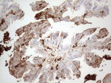 GPNMB / Osteoactivin Antibody - Immunohistochemical staining of paraffin-embedded Adenocarcinoma of Human ovary tissue using anti-GPNMB mouse monoclonal antibody. (Heat-induced epitope retrieval by 1mM EDTA in 10mM Tris buffer. (pH8.5) at 120°C for 3 min. (1:150)