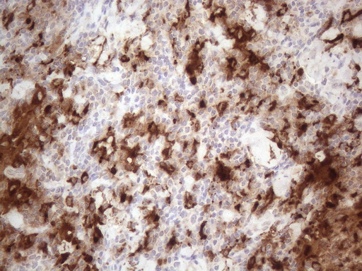 GPNMB / Osteoactivin Antibody - Immunohistochemical staining of paraffin-embedded Human lymph node tissue within the normal limits using anti-GPNMB mouse monoclonal antibody. (Heat-induced epitope retrieval by 1mM EDTA in 10mM Tris buffer. (pH8.5) at 120°C for 3 min. (1:150)