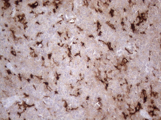 GPNMB / Osteoactivin Antibody - Immunohistochemical staining of paraffin-embedded Human lymphoma tissue using anti-GPNMB mouse monoclonal antibody. (Heat-induced epitope retrieval by 1mM EDTA in 10mM Tris buffer. (pH8.5) at 120°C for 3 min. (1:150)