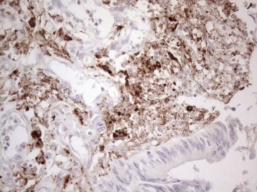 GPNMB / Osteoactivin Antibody - Immunohistochemical staining of paraffin-embedded Adenocarcinoma of Human colon tissue using anti-GPNMB mouse monoclonal antibody. (Heat-induced epitope retrieval by 1mM EDTA in 10mM Tris buffer. (pH8.5) at 120°C for 3 min. (1:150)