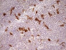 GPNMB / Osteoactivin Antibody - Immunohistochemical staining of paraffin-embedded Human lymphoma tissue using anti-GPNMB mouse monoclonal antibody. (Heat-induced epitope retrieval by 1 mM EDTA in 10mM Tris, pH8.5, 120C for 3min,