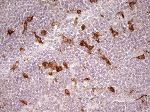 GPNMB / Osteoactivin Antibody - IHC of paraffin-embedded Human lymphoma tissue using anti-GPNMB mouse monoclonal antibody. (Heat-induced epitope retrieval by 1 mM EDTA in 10mM Tris, pH8.5, 120°C for 3min).
