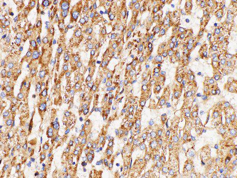 GPNMB / Osteoactivin Antibody - Immunohistochemistry of paraffin-embedded Human liver cancer using GPNMB Polycloanl Antibody at dilution of 1:200