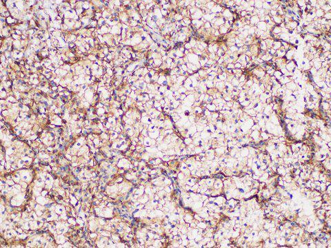 GPNMB / Osteoactivin Antibody - Immunohistochemistry of paraffin-embedded Human renal clear cell carcinoma using GPNMB Polycloanl Antibody at dilution of 1:200