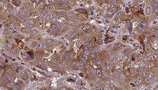 GPR1 Antibody - 1:100 staining human liver carcinoma tissues by IHC-P. The sample was formaldehyde fixed and a heat mediated antigen retrieval step in citrate buffer was performed. The sample was then blocked and incubated with the antibody for 1.5 hours at 22°C. An HRP conjugated goat anti-rabbit antibody was used as the secondary.