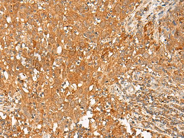 GPR1 Antibody - Immunohistochemistry of paraffin-embedded Human cervical cancer tissue  using GPR1 Polyclonal Antibody at dilution of 1:50(×200)