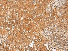 GPR1 Antibody - Immunohistochemistry of paraffin-embedded Human cervical cancer tissue  using GPR1 Polyclonal Antibody at dilution of 1:50(×200)