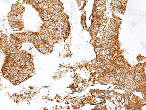GPR119 Antibody - Immunohistochemistry of paraffin-embedded Human colorectal cancer tissue  using GPR119 Polyclonal Antibody at dilution of 1:45(×200)
