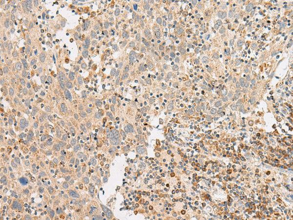 GPR119 Antibody - Immunohistochemistry of paraffin-embedded Human cervical cancer tissue  using GPR119 Polyclonal Antibody at dilution of 1:45(×200)
