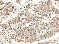 GPR139 Antibody - Immunohistochemistry of paraffin-embedded Human lung cancer tissue  using GPR139 Polyclonal Antibody at dilution of 1:50(×200)