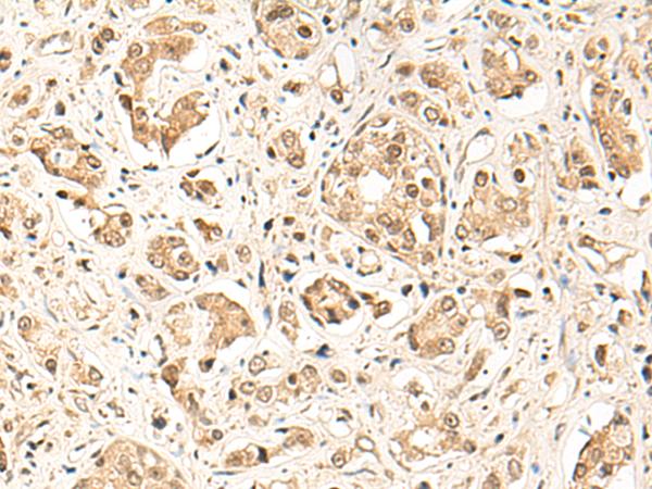 GPR139 Antibody - Immunohistochemistry of paraffin-embedded Human prost ate cancer tissue  using GPR139 Polyclonal Antibody at dilution of 1:50(×200)
